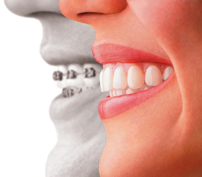 Braces & Aligners