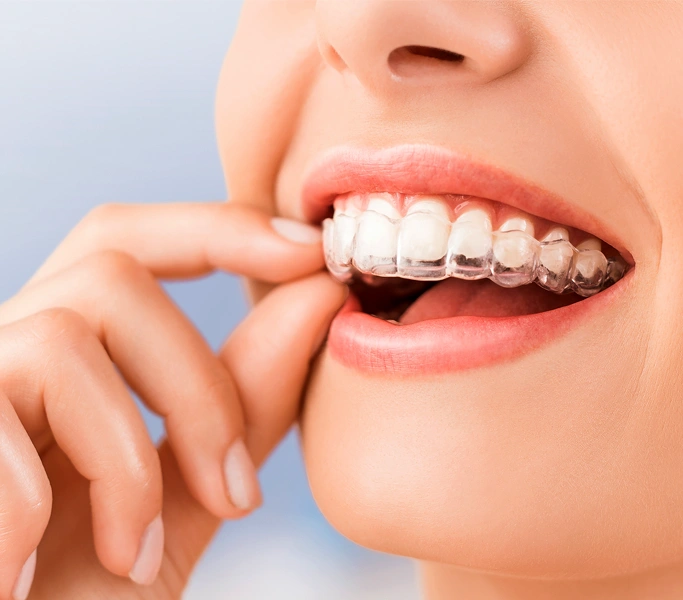 clear aligners