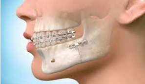 Surgical orthodontics