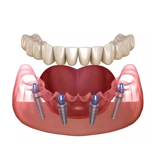 Fix teeth in a day with DENTAL IMPLANTS