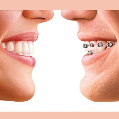 clear aligners vs clear braces